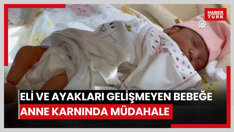 Eli ve ayakları gelişmeyen bebeğe anne karnında müdahale