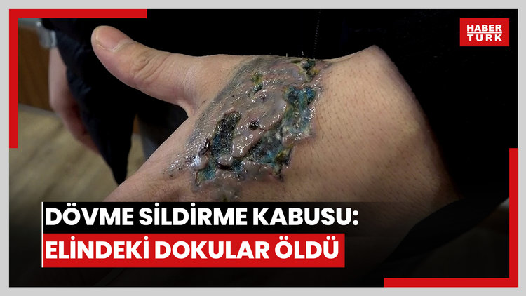Dövme sildirmek isterken kabusu yaşadı: Elindeki dokular öldü