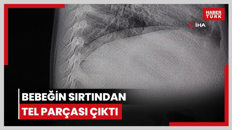 Bebeğin sırtından tel parçası çıktı