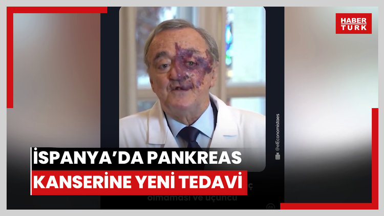 İspanya'da pankreas kanserine karşı umut veren tedavi yöntemi geliştirildi