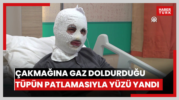 Çakmağına gaz doldurduğu tüpün patlamasıyla yüzü yandı