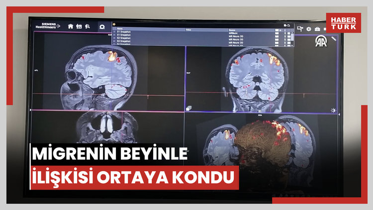 Migrenin beyindeki görsel işlemleme ve ağrı mekanizmalarıyla ilişkisi ortaya kondu