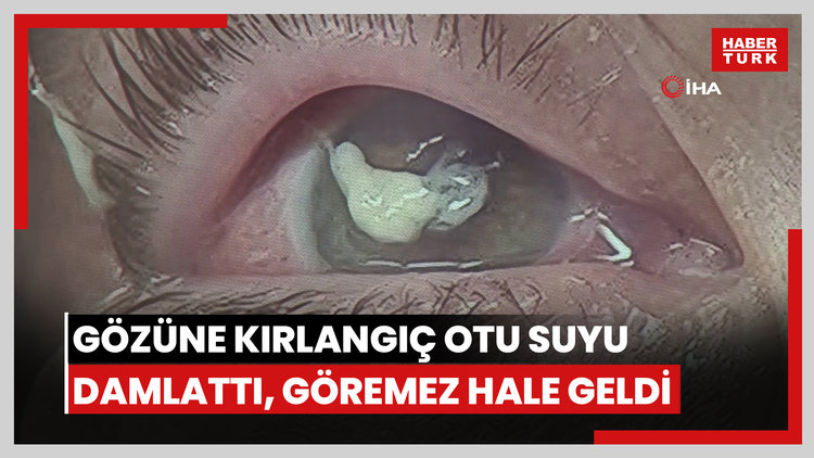 Gözüne kırlangıç otu suyu damlattı, göremez hale geldi