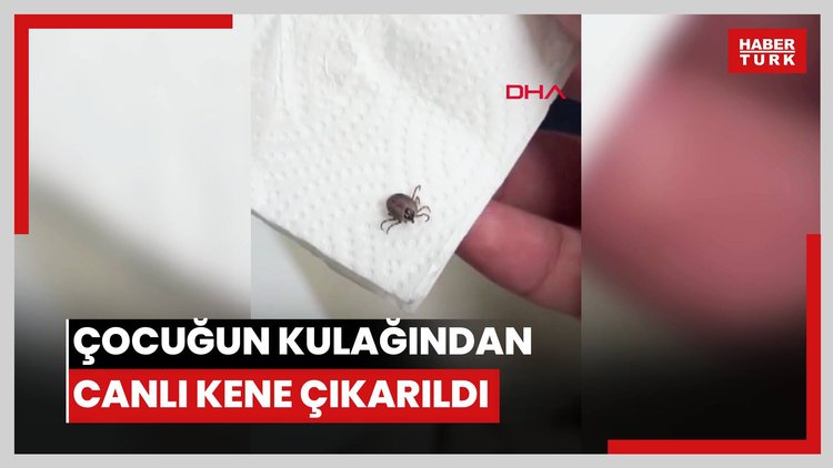 Çocuğun kulağından canlı kene çıkarıldı