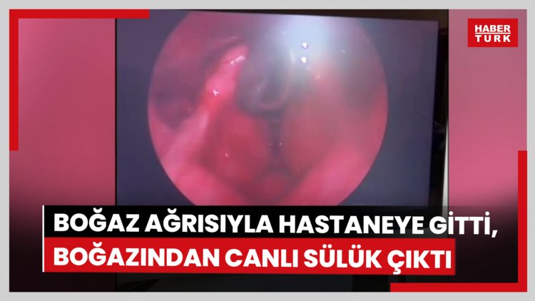 Şiddetli boğaz ağrısı şikayetiyle hastaneye gitti, boğazından canlı sülük çıktı